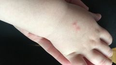 Chicken pox