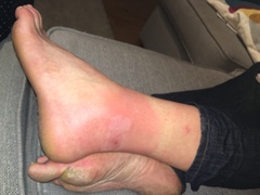 Opinions on DH's bite please?
