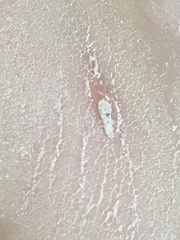 Chicken pox for a third time!