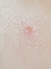 Chicken pox for a third time!