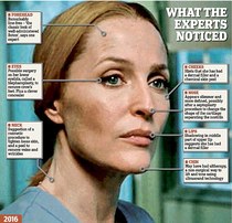 To think no-one looks good with cheek fillers?
