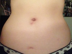 Scar healing after fallopian cyst