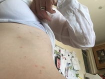 What are these, Rash, blisters? They are spreading, help!!