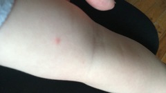 Chicken pox