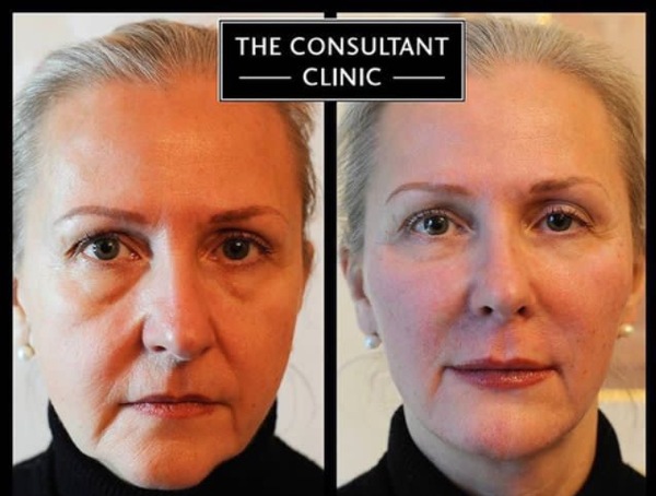 If you don't go down the surgical route how do you stop your face from drooping ?