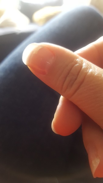 Can I salvage this broken thumb nail? (Pic)