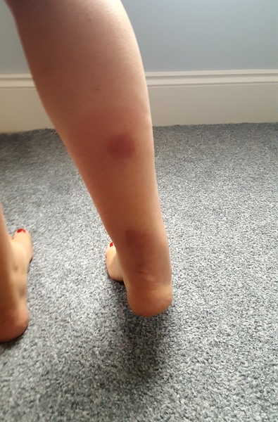 Painful insect bites with photo