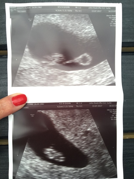 Anyone just found out they're preggers and want some buddies?