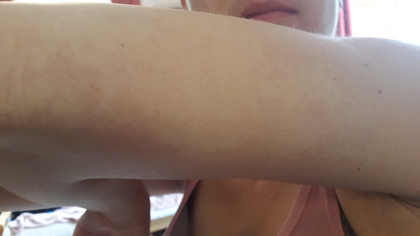 What's up with the skin on my leg? (photo)