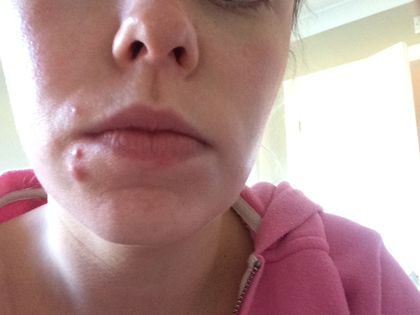 Adult acne - cystic - one spot at a time - advice?