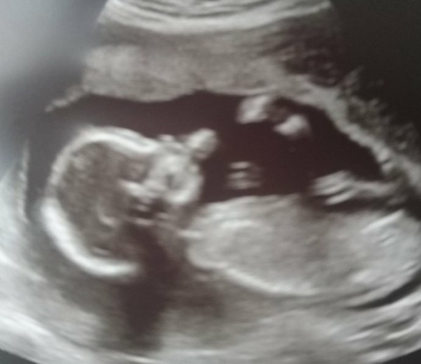 Hyperemesis Support