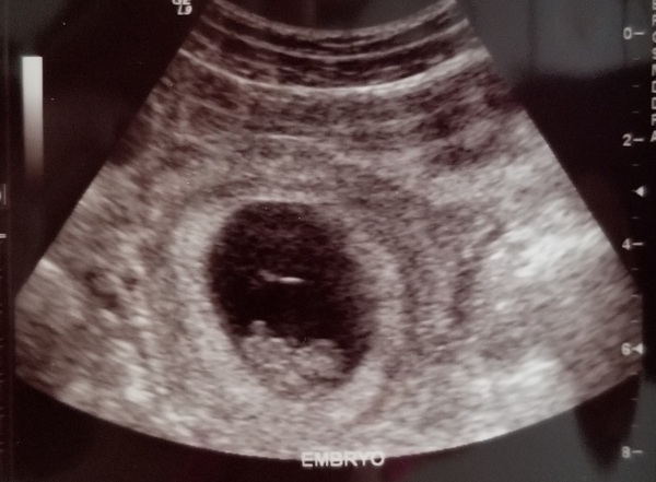 Pregnancy buddies due mid Feb 2018.