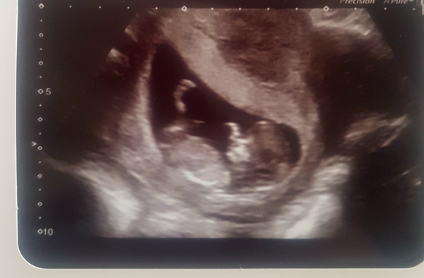 Pregnancy buddies due mid Feb 2018.