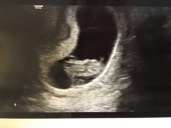 Pregnancy buddies due mid Feb 2018.