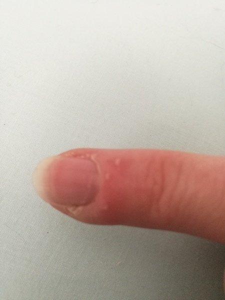 Infected cuticle?? No pus yet but it's red, hot and angry *pic*