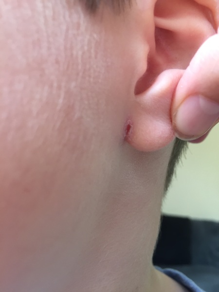 Not happy my kids regularly get sore ears - where the lobe meets the face