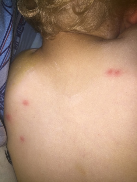 To ask is this normal with chicken pox? Traffic post!