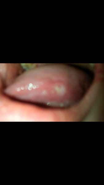 Long lasting mouth ulcer thing