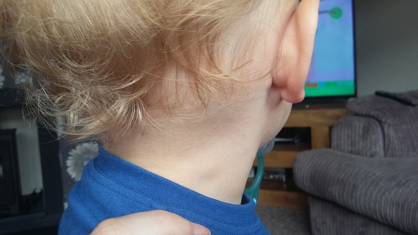 Swollen Gland - one side of neck
