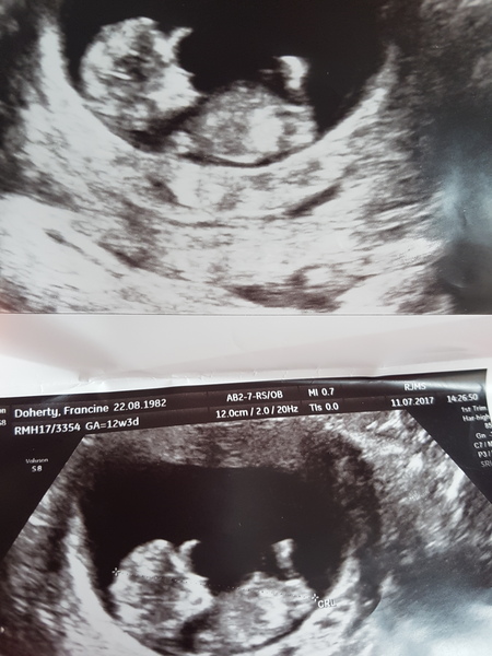 12 week scan/ nub theory?