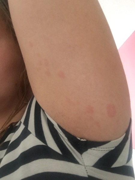 Rash under arm (pic)
