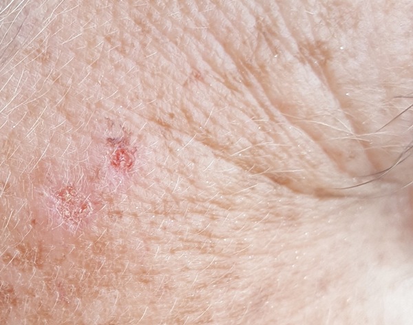 Worried by scabs/marks developed on face during very sunny holiday