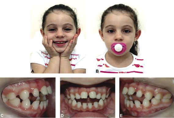 5 year old still has a dummy and bottle: is it really that bad?