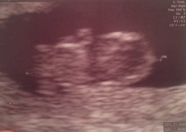 Pregnancy buddies due mid Feb 2018.