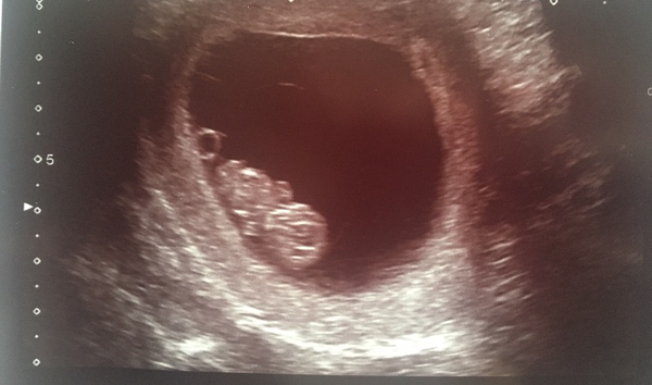 Pregnancy buddies due mid Feb 2018.