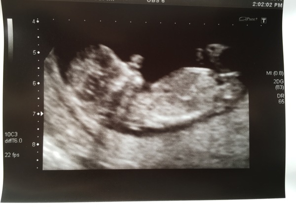 12 week scan today and terrified....