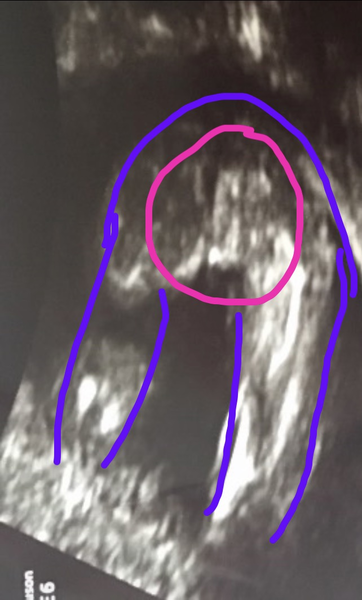 Conflicting gender scans (private v NHS) - anyone else?