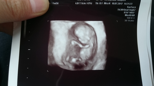Hyperemesis Support