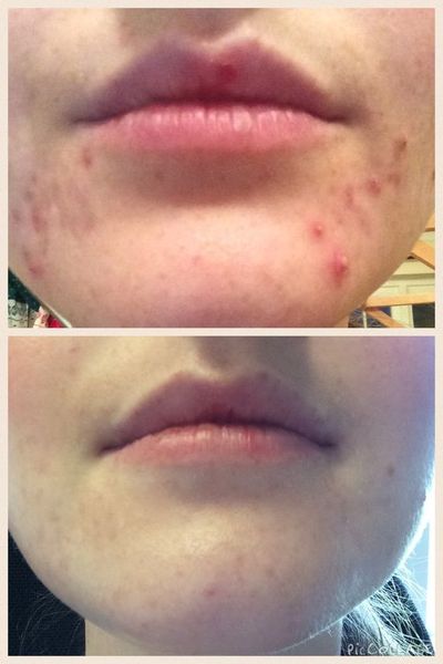 Adult acne - cystic - one spot at a time - advice?