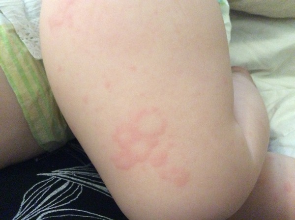Anyone help with this rash? Hives maybe?