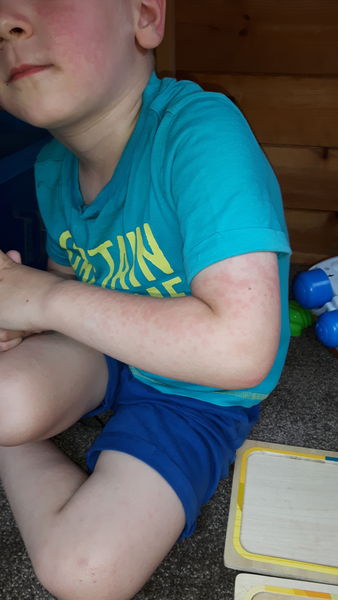 What does this rash look like?