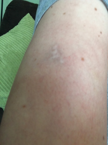Does tattoo removal actually work?