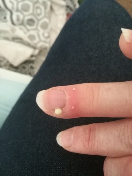Infected cuticle?? No pus yet but it's red, hot and angry *pic*