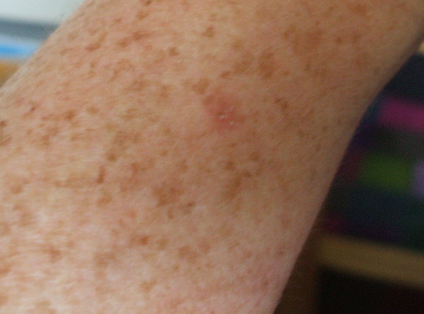 Check out this horse fly bite (pic)