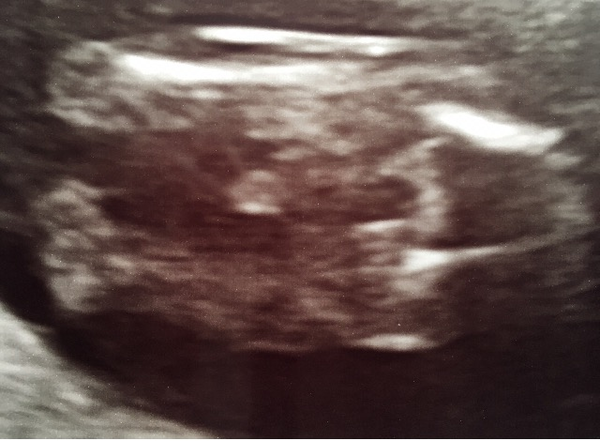 Conflicting gender scans (private v NHS) - anyone else?