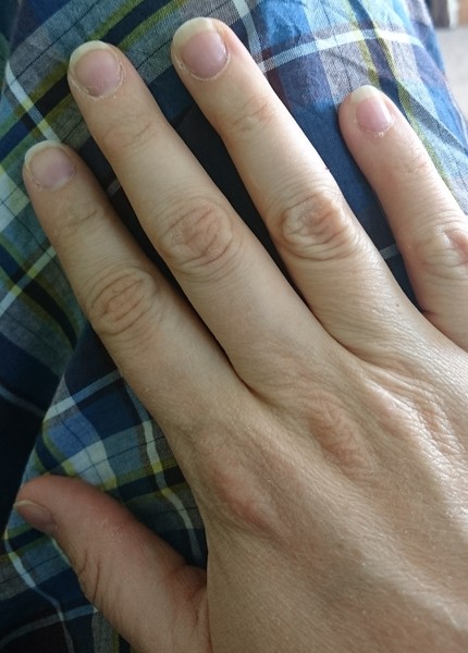Nail biting