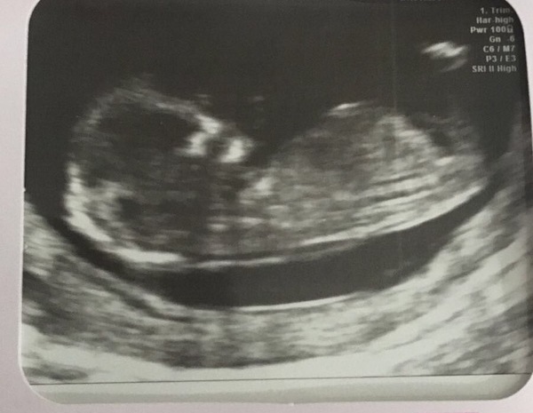 Gender guesses for my 12 week scan?