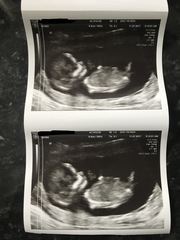 Gender guess 13 weeks