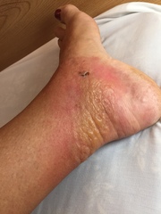Help please?  Burning ankles swelling urticaria.