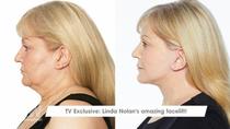 Could a £6000 facelift really achieve these results?