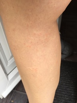 Does this look like bed bug bites?