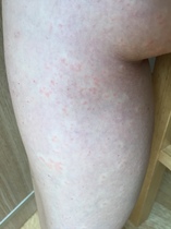Does this look like bed bug bites?