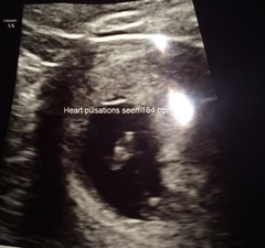 Not sure what to expect at early scan