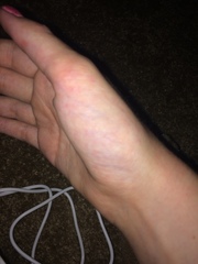 Broken thumb ?