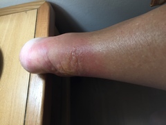 Help please?  Burning ankles swelling urticaria.