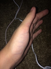 Broken thumb ?
